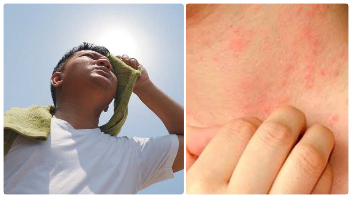 வியர்க்குரு உடலில் அதிகமாக வருகிறதா.. அதனை போக்க சூப்பர் வழிகள்.. ஆனால்