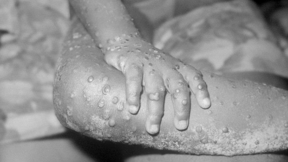 Symptoms of monkeypox
