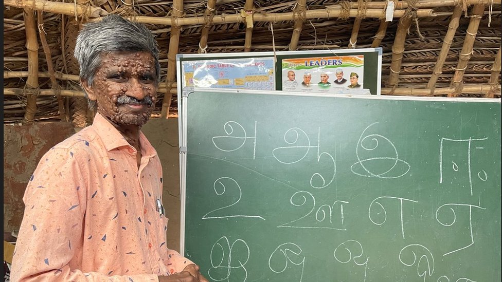 மரபணு குறைபாட்டால் மாறிய முகம்